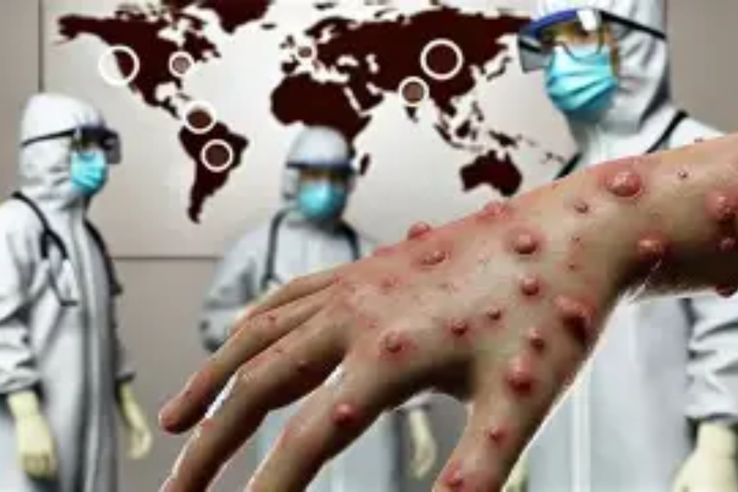 Porto Velho reforça monitoramento da Mpox após confirmação de novos casos na capital
